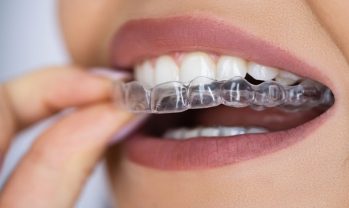 Clear Aligner Dental Night Guard For Teeth